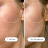 VOTARY Sensitive Resurfacing Peel reveals younger-looking, fresher skin