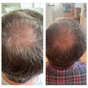 Agent Nateur Holi (Growth) 84 Scalp Spray features clinically-backed ingredients and a luxurious botanical blend, this clean formula promotes visible growth in as little as 84 days.